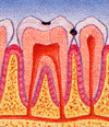 tooth decay
