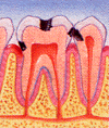 tooth decay