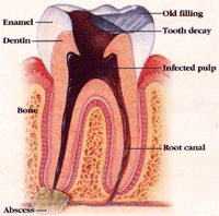 root canal treatment