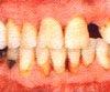 periodontitis