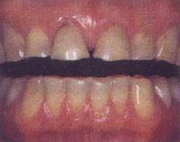 before veneers