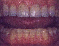 after veneers