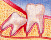wisdom teeth