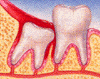 wisdom teeth