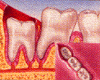 wisdom teeth
