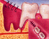 wisdom teeth